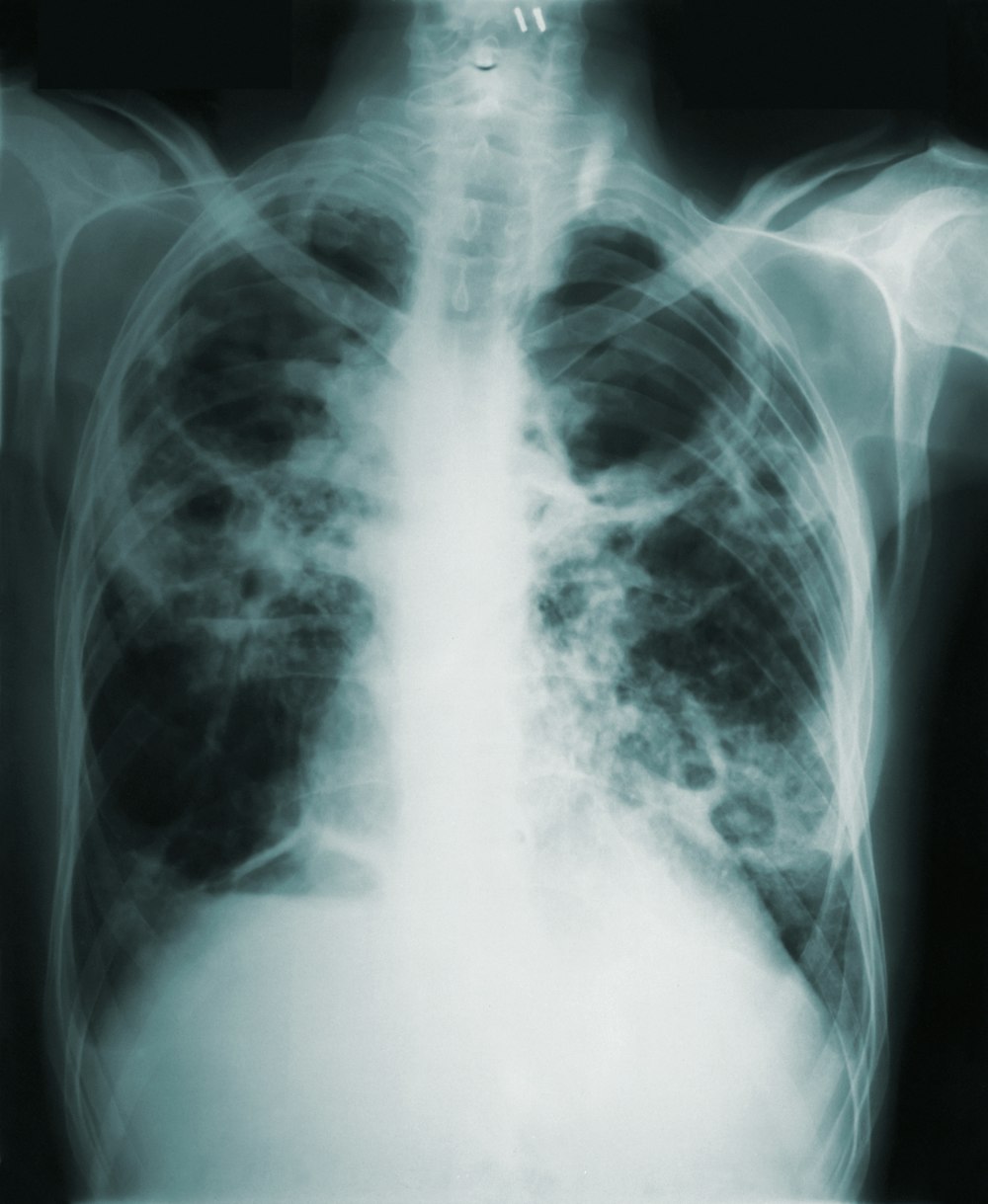 uma imagem de raio-x do peito de um homem