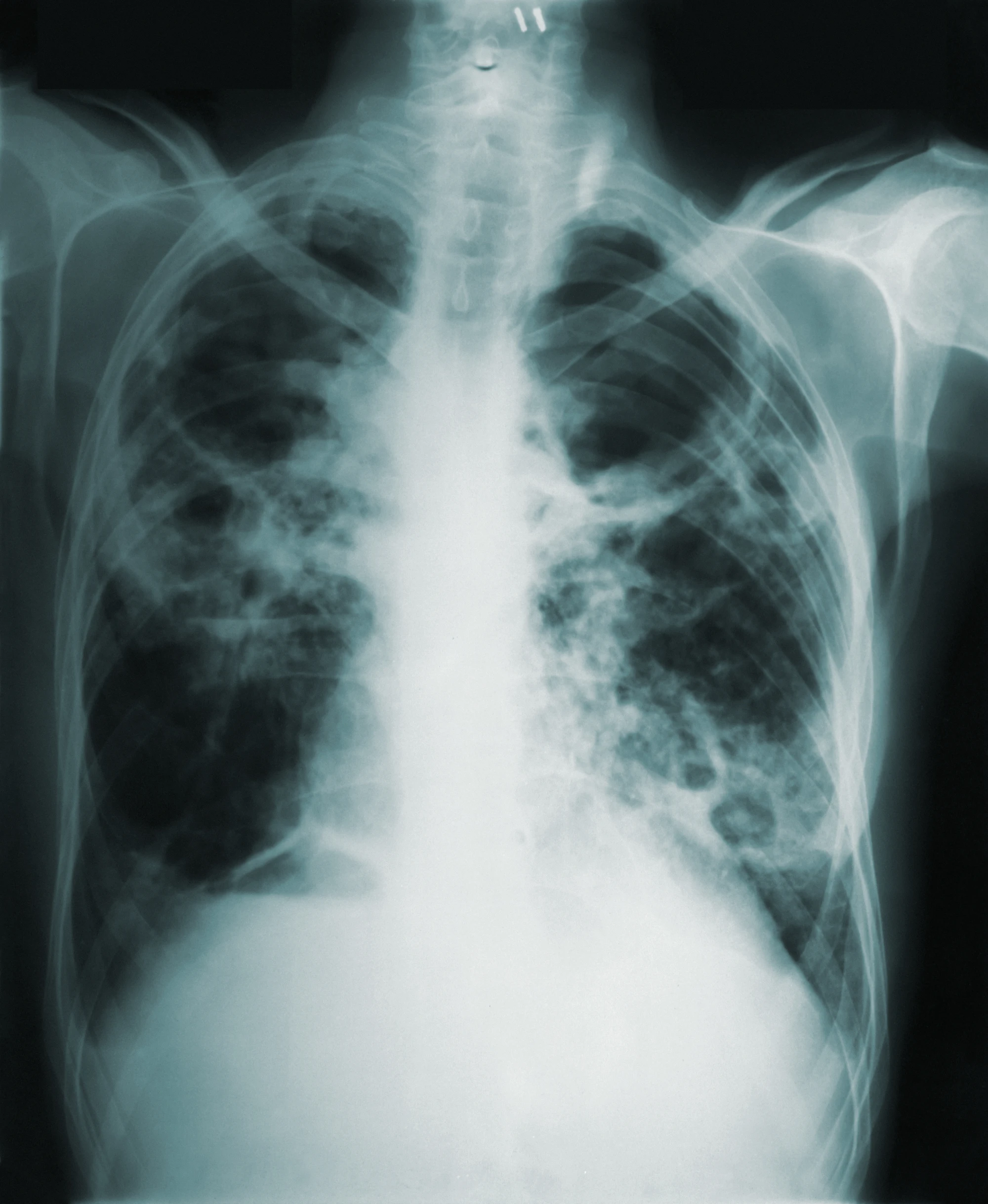 Radiografia digital de tórax vista em negatoscópio