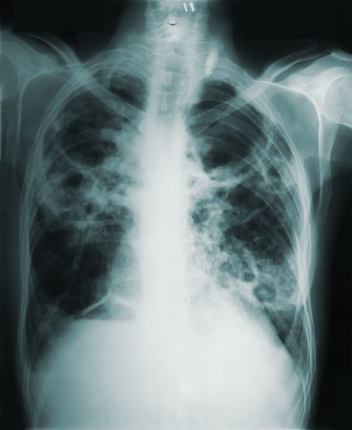 Tuberculosis