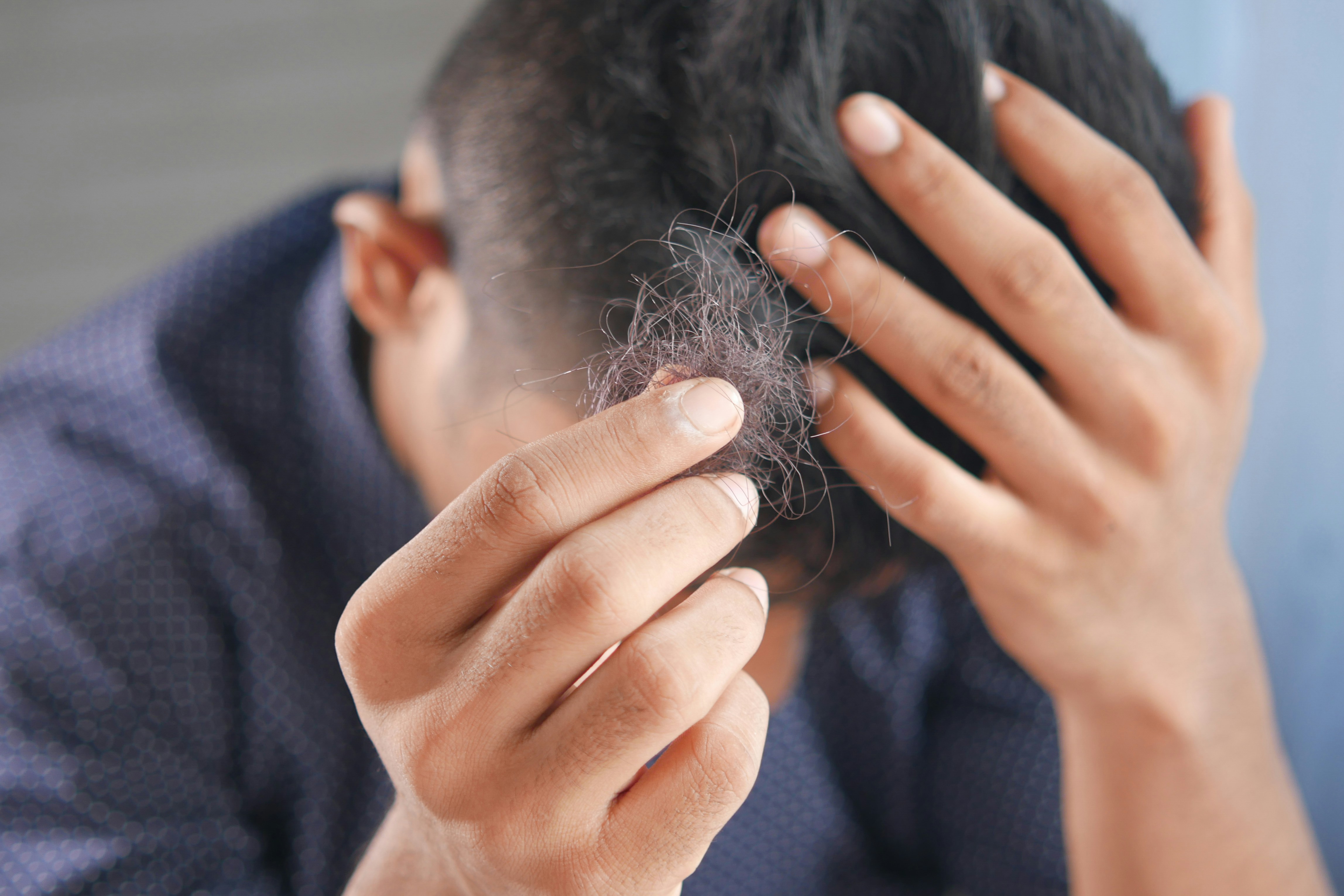 How To Reverse Baldness In Male - Bright Cures