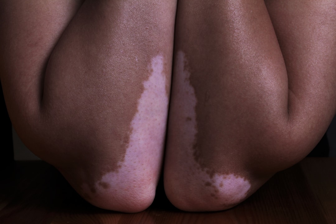 vitiligo heilen