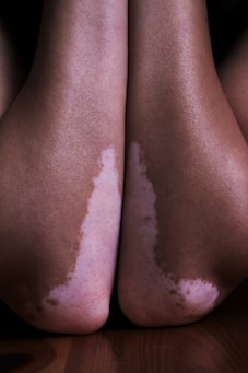 a close up of a person's legs with white spots on them