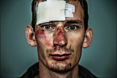 Before and after images showing facial reconstruction of a patient after trauma.