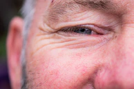 Side-by-side comparison of before and after blepharoplasty on a middle-aged man.