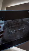 A dental panoramic X-ray image displayed against a light source, revealing teeth structures and fillings. The X-ray appears to be held from below by a person’s hand.
