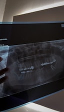 A dental panoramic X-ray image displayed against a light source, revealing teeth structures and fillings. The X-ray appears to be held from below by a person’s hand.