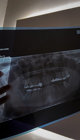 A dental panoramic X-ray image displayed against a light source, revealing teeth structures and fillings. The X-ray appears to be held from below by a person’s hand.