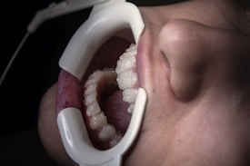 a close up of a person's mouth with a dental device attached to it