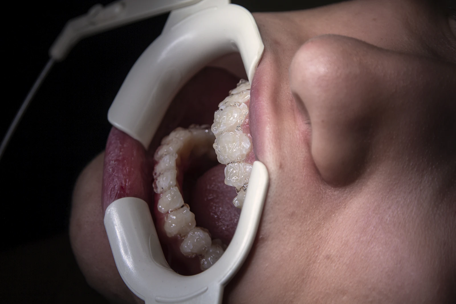 Primer plano de la boca con dispositivo dental colocado durante el diseño de sonrisa