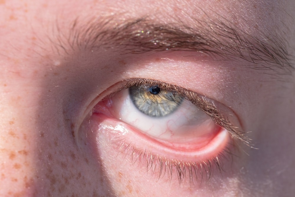 a close up of a persons eye with freckles on it