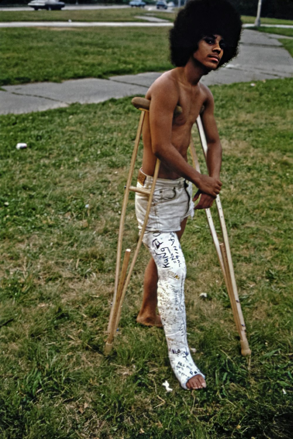 Un hombre sin camisa con muletas y una pierna rota