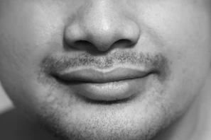 Before and after photos showing subtle, natural facial rejuvenation results