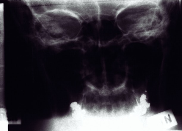 An X-ray image of the human skull, displaying clear outlines of the cranium, eye sockets, and nasal cavity. The image has a monochrome color palette, typical for X-ray images, with variations in brightness indicating different densities of bone and tissue.