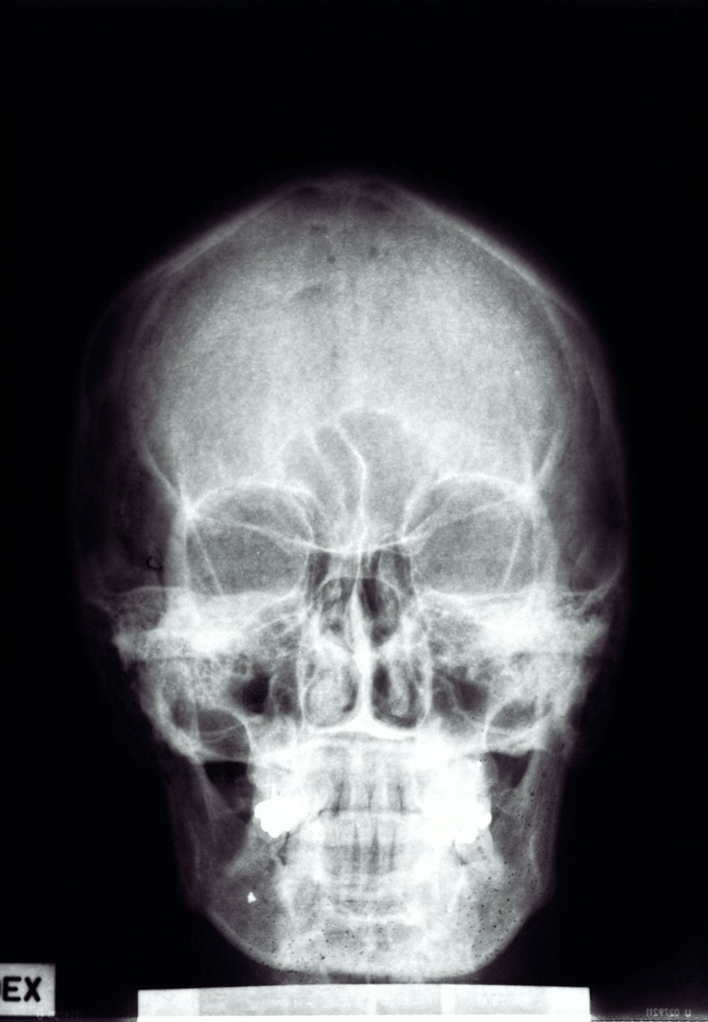 a x - ray of a human skull with a black background