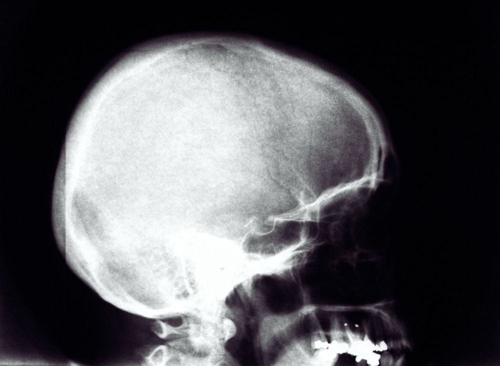 a black and white photo of a human skull