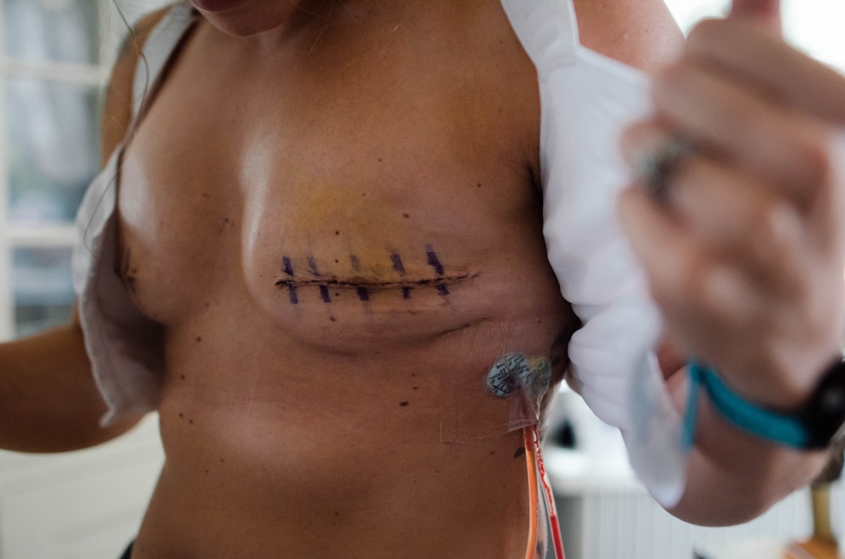Breast Reconstruction procedure planning image