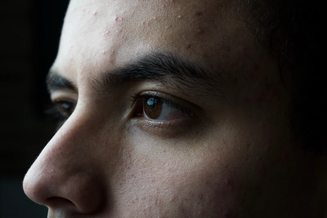Close-up of a man's face with active acne and texture