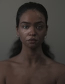 A young woman with vitiligo, a condition causing patches of depigmented skin, is gazing directly into the camera. Her long, dark hair is pulled back, and she wears small hoop earrings. The background is solid and neutral in color, enhancing the focus on her face.