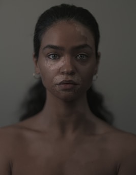 A close-up of a woman's face with melasma spots.