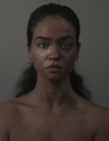 A young woman with vitiligo, a condition causing patches of depigmented skin, is gazing directly into the camera. Her long, dark hair is pulled back, and she wears small hoop earrings. The background is solid and neutral in color, enhancing the focus on her face.