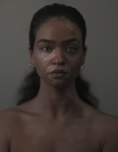 A young woman with vitiligo, a condition causing patches of depigmented skin, is gazing directly into the camera. Her long, dark hair is pulled back, and she wears small hoop earrings. The background is solid and neutral in color, enhancing the focus on her face.
