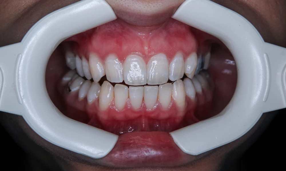 A new smile with veneers