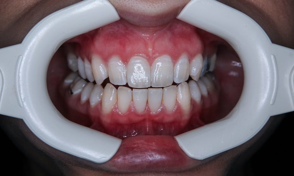 a person's mouth with teeth