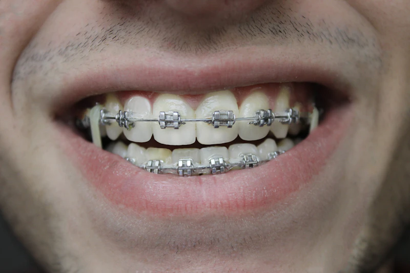 Close-up dental treatment view illustrating orthodontic care