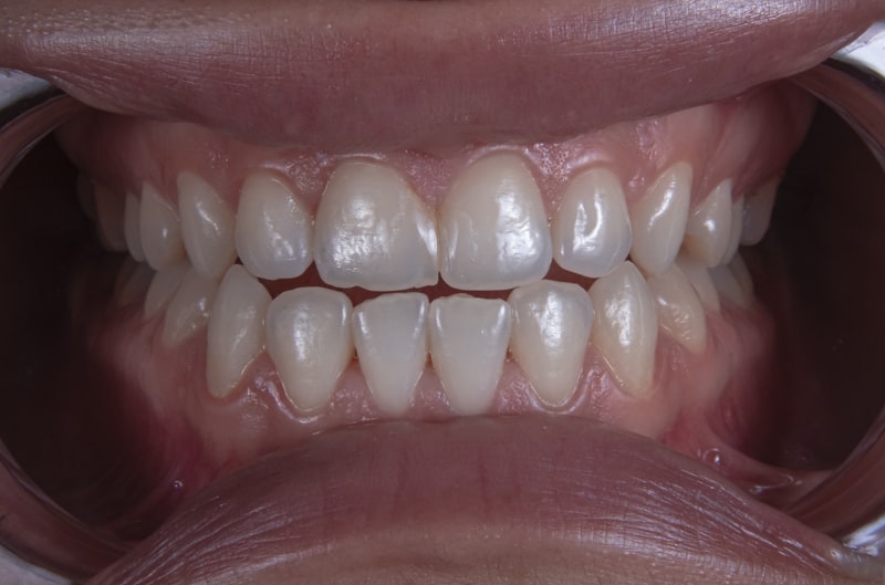 Clear aligners for teeth straightening