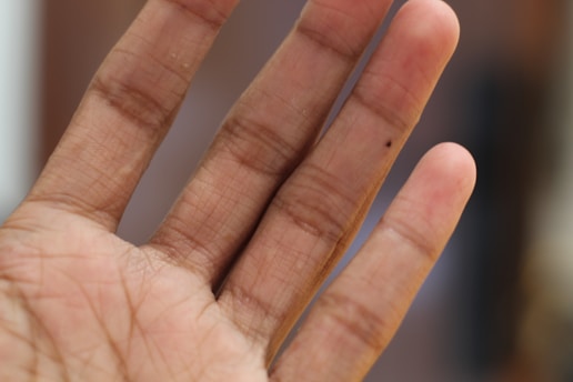 Close-up of a mole removal procedure being gently performed on skin.