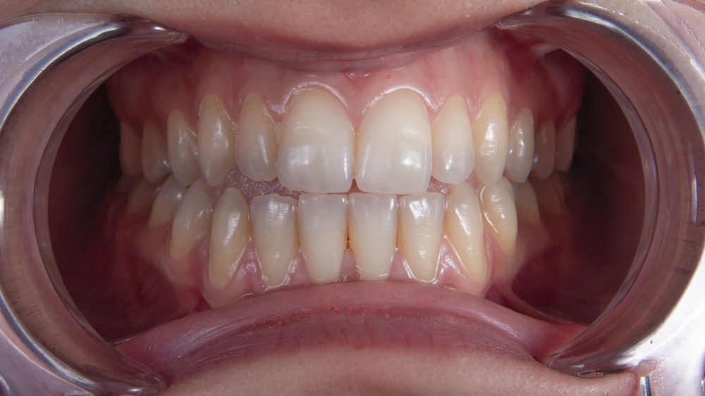 a person's mouth with teeth
