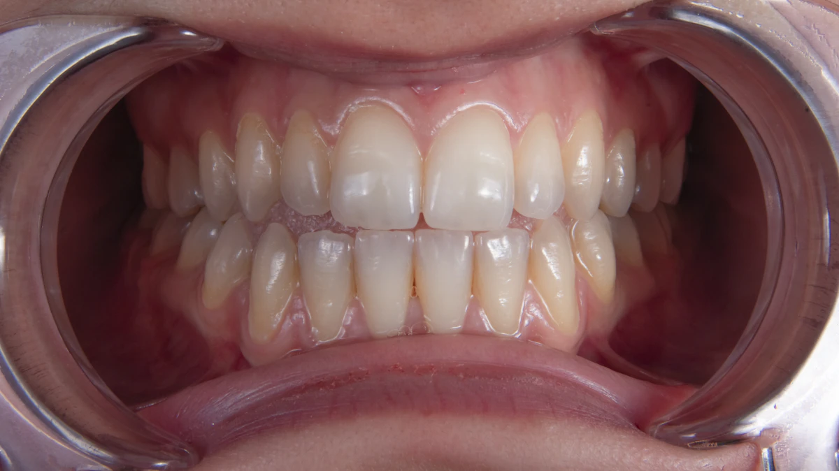 İllüstratif görsel: a person's mouth with teeth