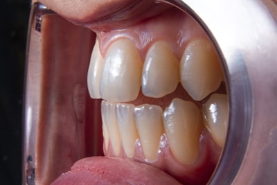a person's mouth with teeth