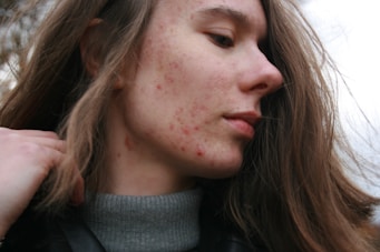 Acne - Rosacea