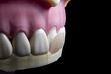 A close-up view of a dental model showcasing a row of artificial teeth with pale pink gums. A dental veneer is partially attached to one of the front teeth.