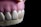 A close-up view of a dental model showcasing a row of artificial teeth with pale pink gums. A dental veneer is partially attached to one of the front teeth.