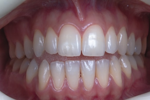 Close-up view of a set of healthy human teeth showing both the upper and lower rows. The teeth appear white and well-aligned, with visible gums that look pink and healthy. The lighting highlights the natural shine and texture of the enamel.