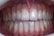 Close-up view of a set of healthy human teeth showing both the upper and lower rows. The teeth appear white and well-aligned, with visible gums that look pink and healthy. The lighting highlights the natural shine and texture of the enamel.