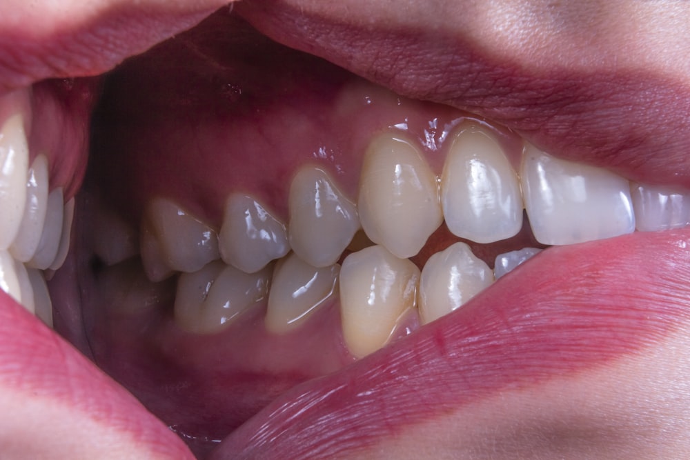 a person's mouth with teeth showing