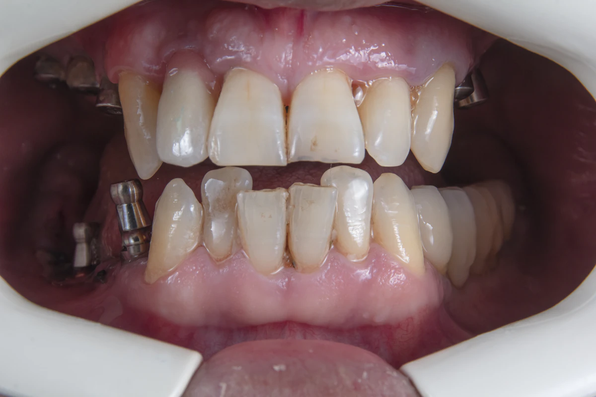 İllüstratif görsel: a person's mouth with teeth and tongue