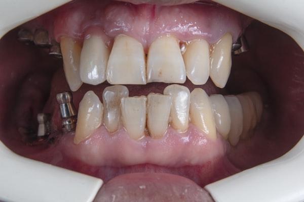 Blanchiment Dentaire