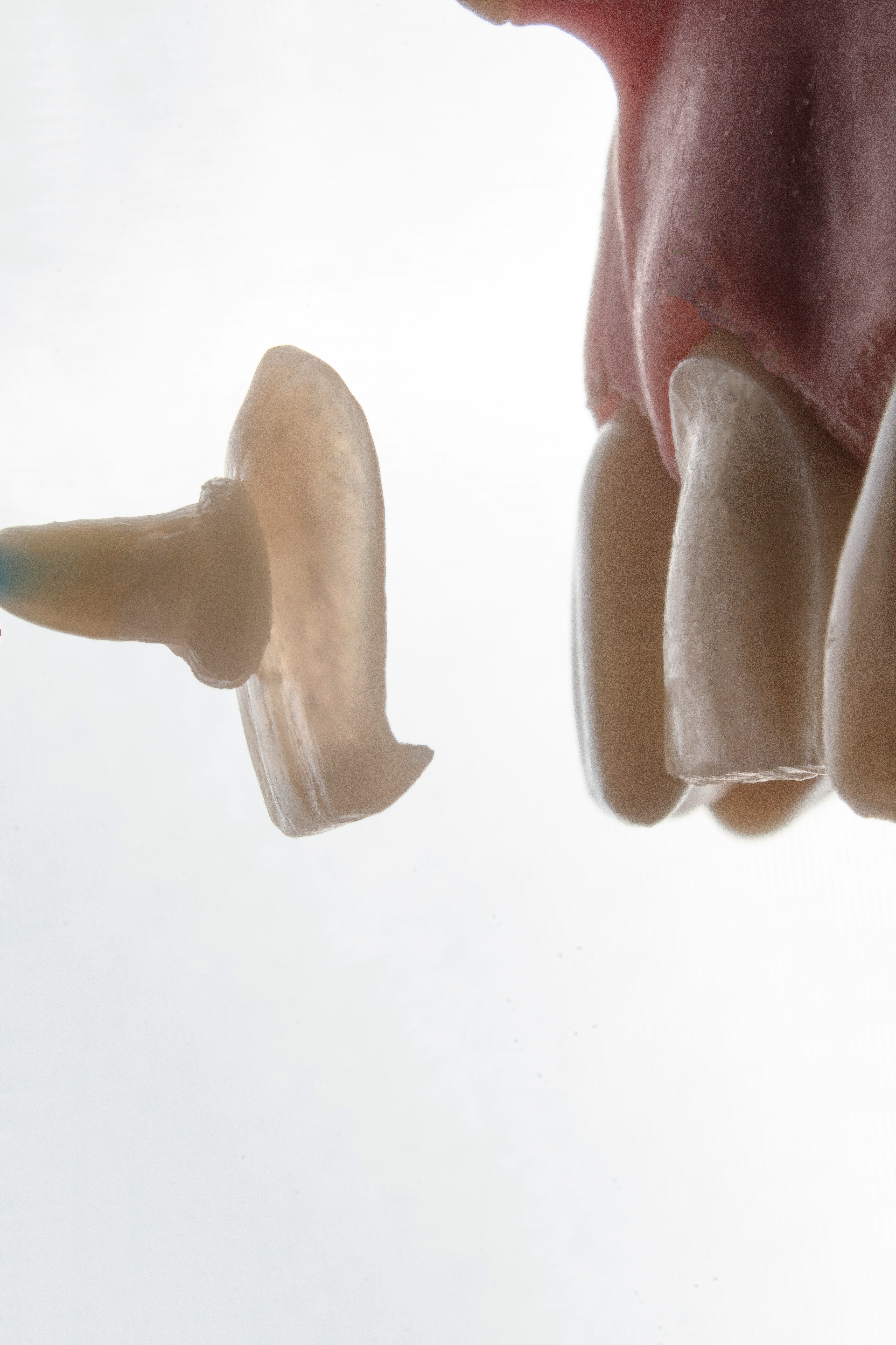 Overdenture