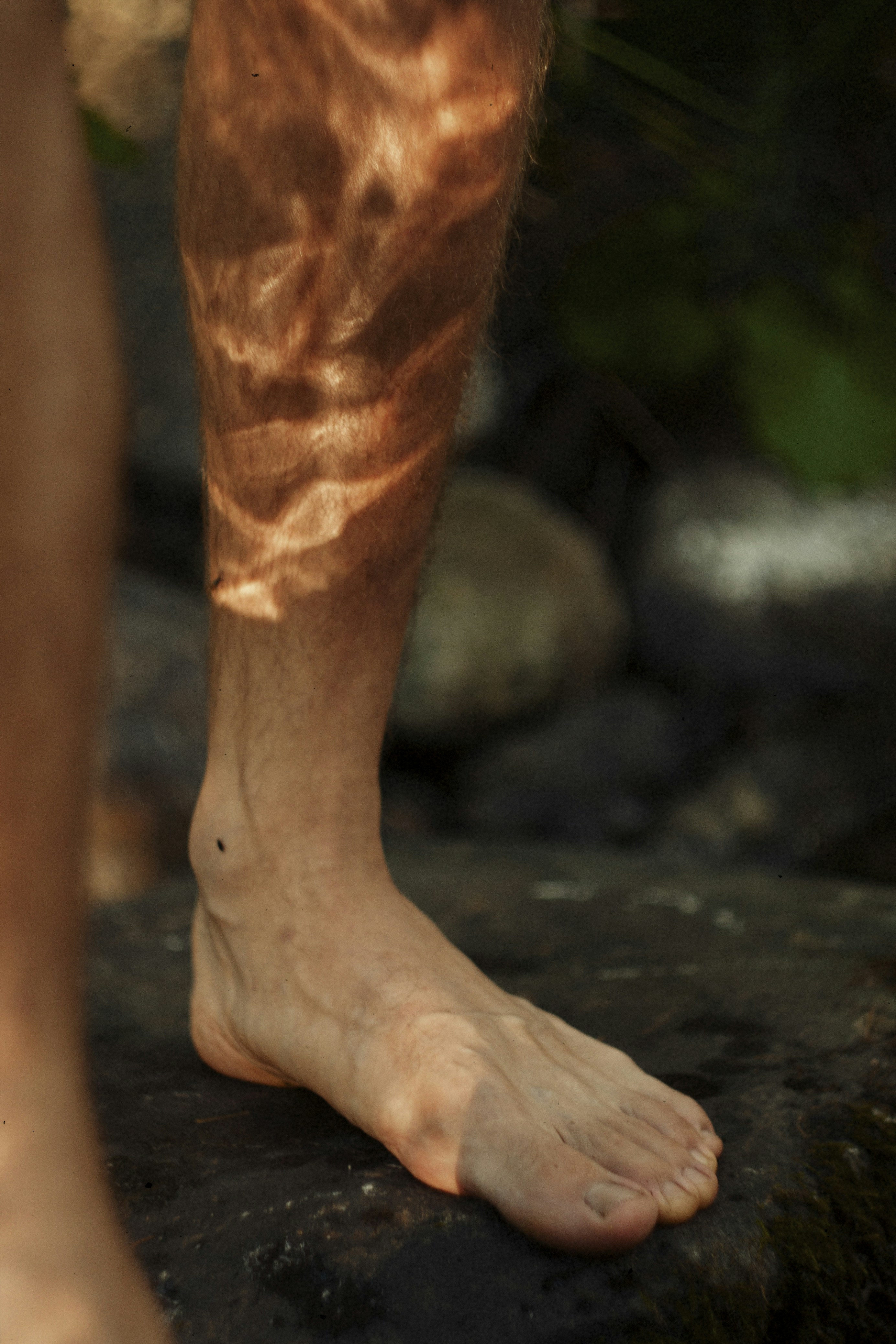 Варикоз вен