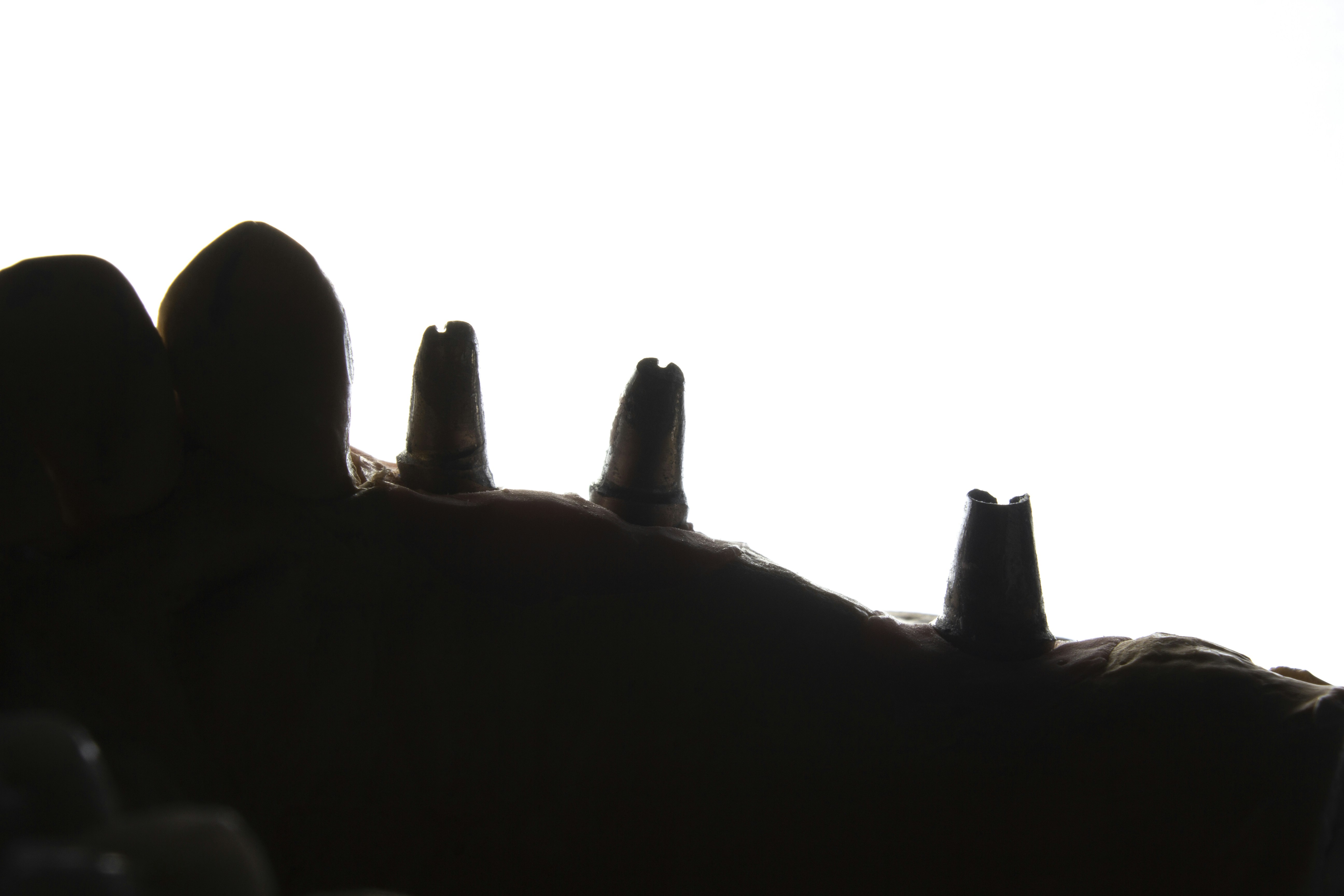 Best Dental Implant Dentist Near Me Johnstown OH