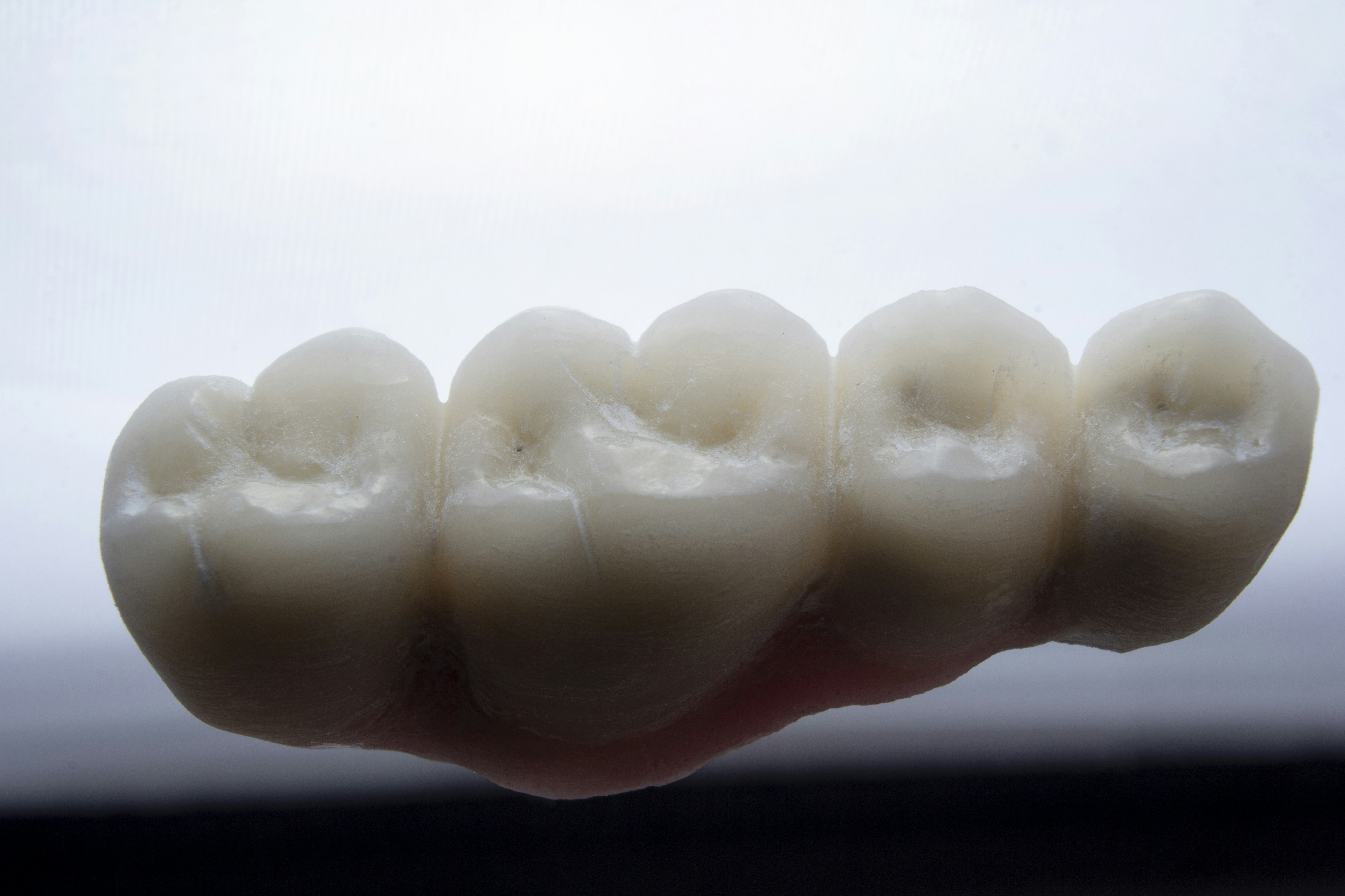 dental bridges vs implants​