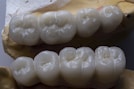 A detailed view of dental crowns or bridges placed on a dental mold, displaying the intricate grooves and textures of the artificial teeth.