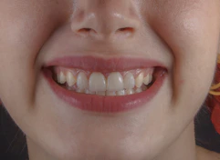 Healthy gums after treatment of bleeding gums by gums specialist