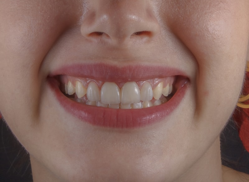 Complete & Partial Dentures