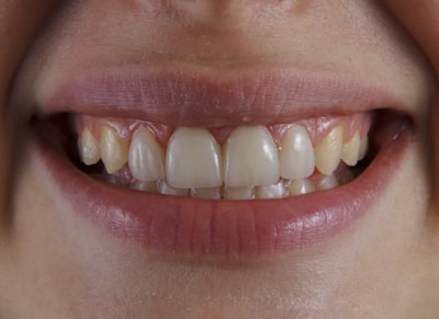 Close-up of a smile showing worn and chipped edges on the front teeth