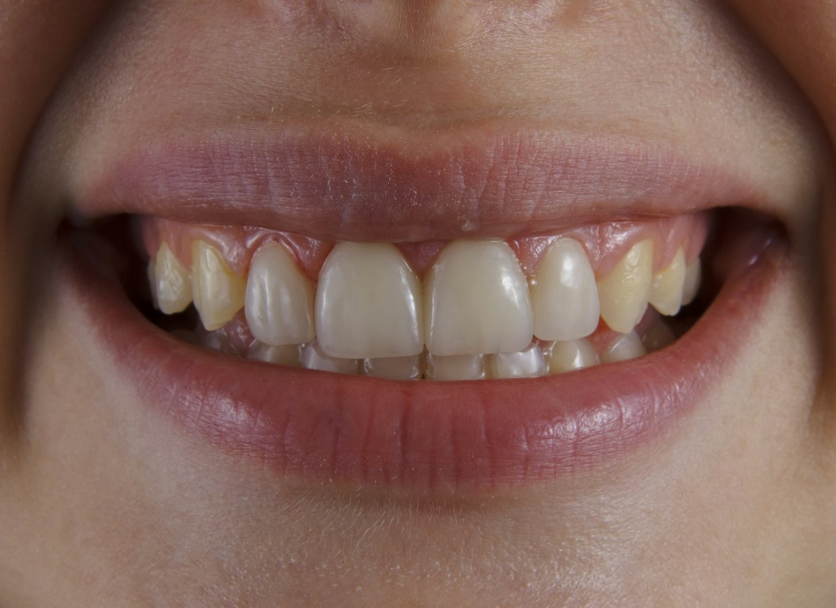 Cracked Tooth: When Is It an Emergency and When Can It Wait? — Lake Jeanette Family & Implant Dentistry Greensboro NC